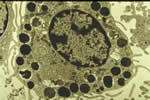 Mastocyte : cette cellule immunitaire contenant de nombreuses granulations dans son cytoplasme a un rôle important dans l'hypersensibilité immédiate. Ces granulations libèrent des médiateurs – par exemple l'histamine - au moment de la réaction allergique © David, B. / Institut Pasteur