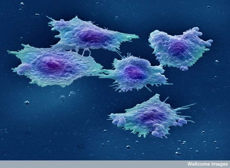 Le cancer colorectal compte parmi les cancers les plus dangereux : troisième pour l'incidence en France en 2012, il passe deuxième en ce qui concerne la mortalité. © Annie Cavanagh, Wellcome Images, cc by nc nd 2.0 Le cancer colorectal compte parmi les cancers les plus dangereux : troisième pour l'incidence en France en 2012, il passe deuxième en ce qui concerne la mortalité. © Annie Cavanagh, Wellcome Images, cc by nc nd 2.0