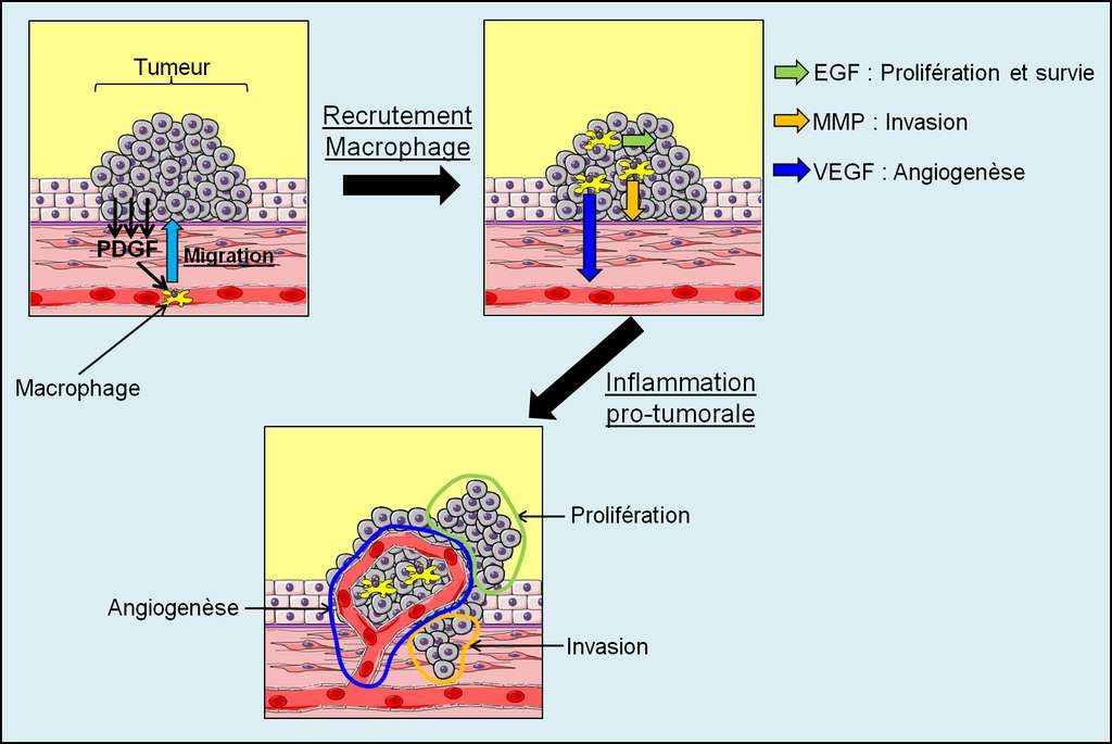 Figure 25. L’inflammation protumorale. Si une tumeur sécrète des facteurs inflammatoires, comme le PDGF, elle peut recruter des macrophages. Les propriétés du macrophage dans la reconstruction des tissus peuvent ensuite être utilisées au profit de la tumeur pour son développement : ces propriétés stimulent la prolifération des cellules cancéreuses, l’angiogenèse tumorale et l’invasion tumorale. © Grégory Ségala