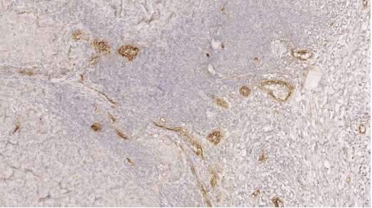 Marquage des vaisseaux HEV (en marron) sur une coupe de tumeur d’un patient atteint de mélanome métastatique et traité par immunothérapie. © Jean-Philippe Girard, IPBS (CNRS/UT3 Paul Sabatier)