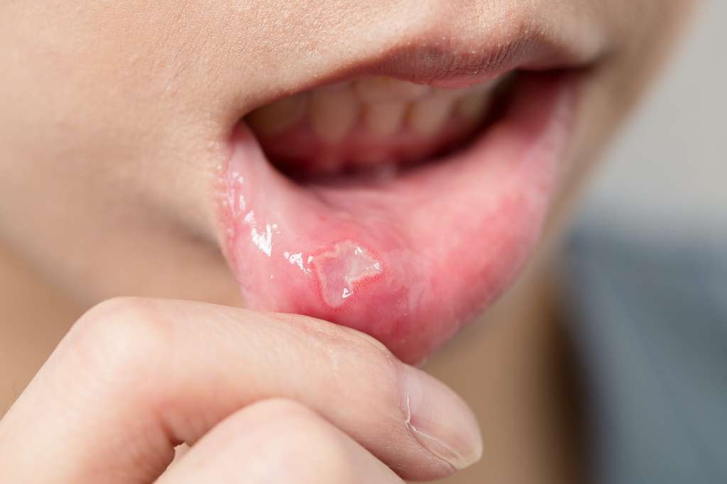 Les aphtes peuvent être localisés derrière la lèvre. © Leungchopan Adobe Stock