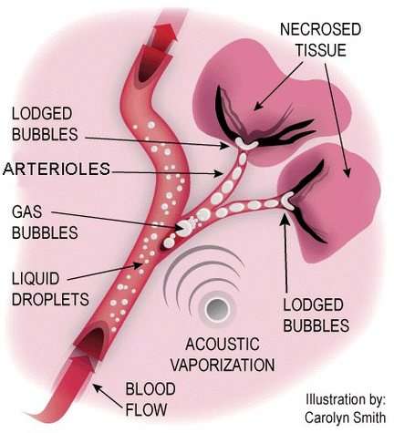Des gouttes de perfluorocarbone liquide soumises à une "vaporisation acoustique" deviennent des bulles de gaz qui peuvent obturer les vaisseaux sanguins irriguant les tumeurs, et provoquer leur nécrose (Crédits : Carolyn Smith)