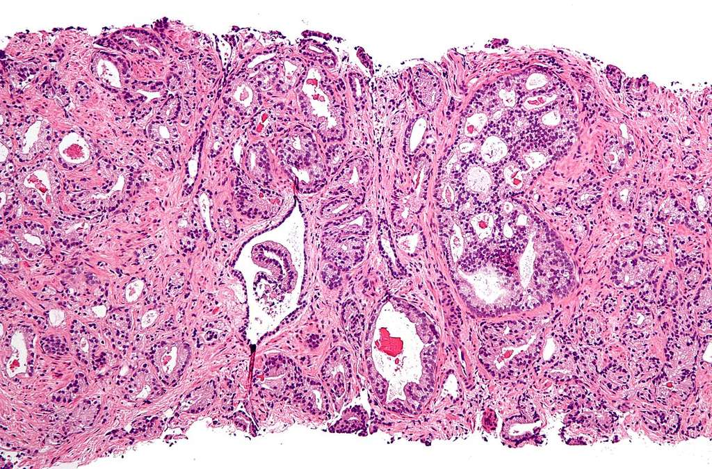 Un adénocarcinome de la prostate en microscopie optique, la forme la plus fréquente de tumeur maligne, indépendante du gène HOXB13. © Nephron, Wikipédia, cc by sa 3.0