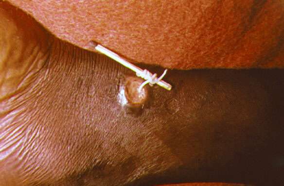 Un ver de Guinée retiré d'un abcès. La technique ancestrale consiste à enrouler le ver sur un bâton et de l'extraire doucement de la plaie sans le rompre. © CDC, domaine public