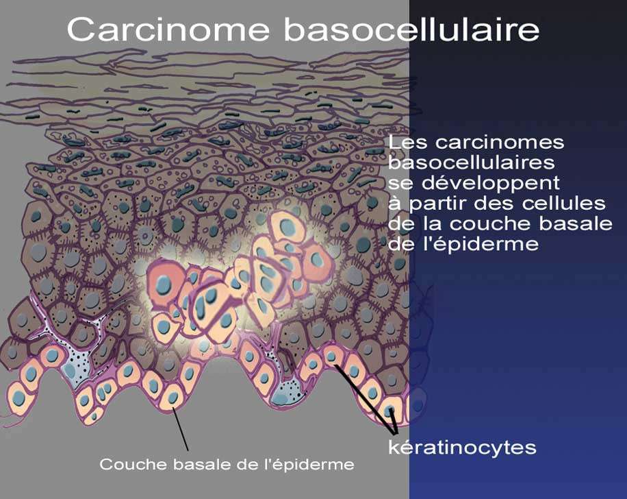Le carcinome basocellulaire siège le plus souvent sur le visage et le dos. © DR