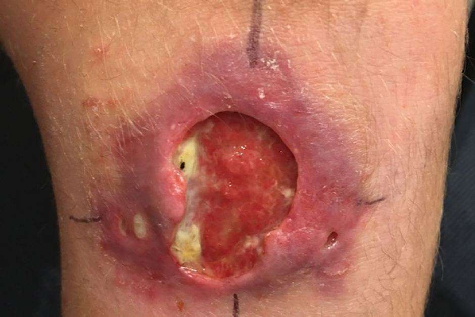 Une lésion au genou due à l’infection par Mycobacterium ulcerans. © Medical Journal of Australia