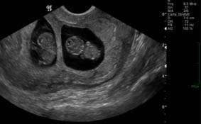 Échographie de grossesse gémellaire bichoriale. © DR