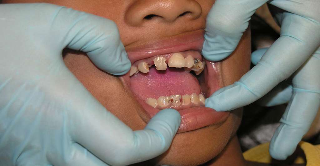Il arrive parfois d'avoir de graves complications dentaires. © Elsebjgmailcom - Domaine public