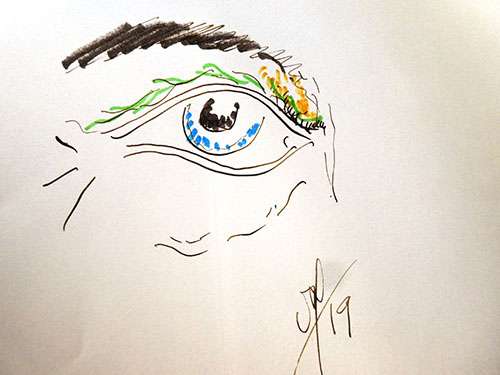 Aspect avant de paupière tombante et fripée. © Dr Mitz, tous droits réservés