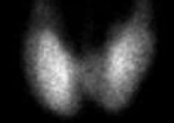 Scintigraphie thyroïdienne : 1 mois d’irradiation naturelle © SFRP