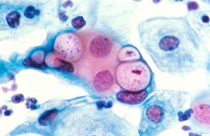 Observation de Chlamidiae dans des cellules humaines. Les chlamidiae sont des micro-organismes qui parasitent les cellules à l'intérieur desquelles elles se développent. Source : Wikipedia, article chlamidia, image provenant de l'administration américaine, domaine public.