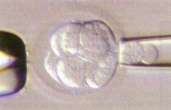 Prélèvement d'une cellule embryonnaire, au cours d'un Diagnostic Préimplantatoire, afin d'en faire l'analyse génétique © The Institute for Reproductive Medicine and Science of St.Barnabas, Etats-Unis
