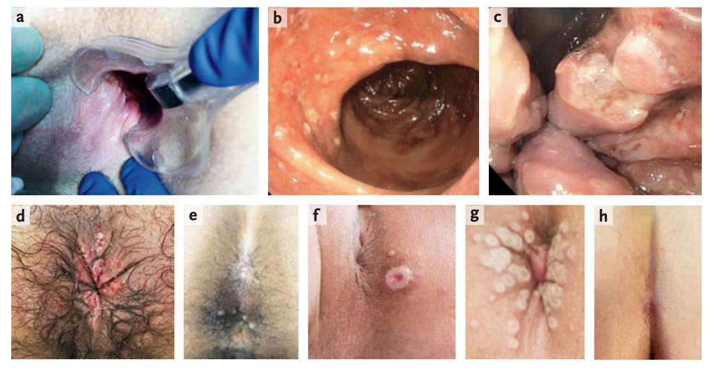 Exemples de lésions anales causées par la variole du singe. © The NEJM