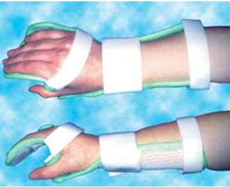 Orthèse d'immobilisation poignet, main, doigts. © http://www.orthopedie-perier.com