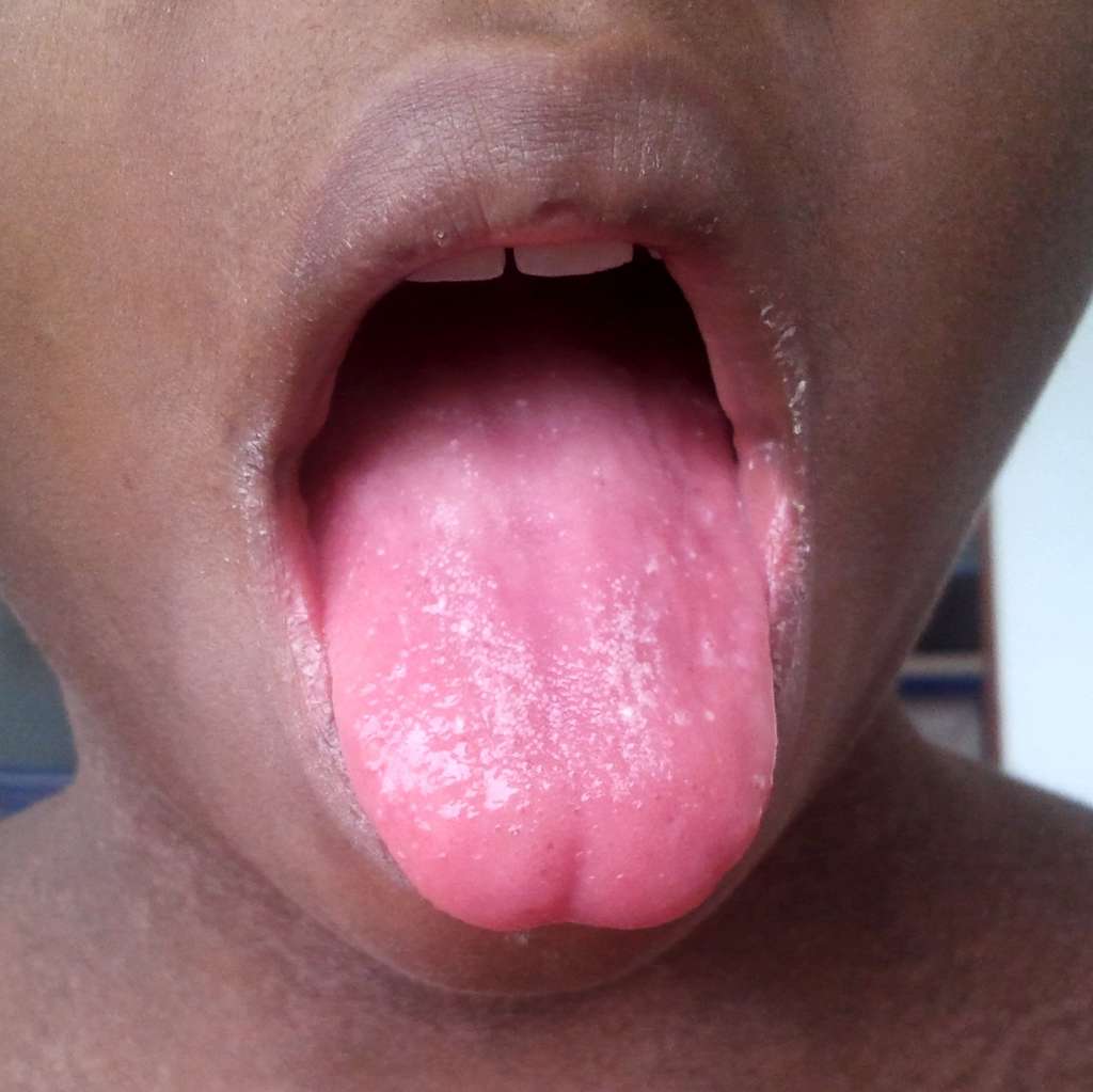 Papillomavirus levres bouche