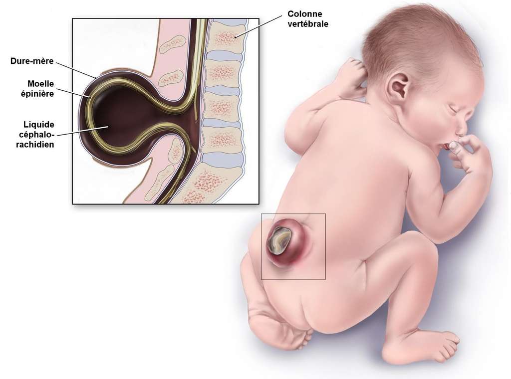 Le spina bifida est causé par une fermeture incomplète du tube neural pendant le développement de l’embryon. Certaines vertèbres mal formées restent ouvertes. Une partie de la moelle épinière peut alors sortir de la colonne vertébrale. © Domaine public