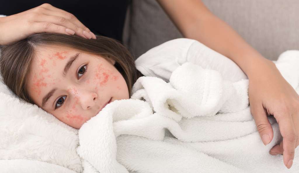 Depuis Quand Le Vaccin Contre La Rougeole Est Il Obligatoire