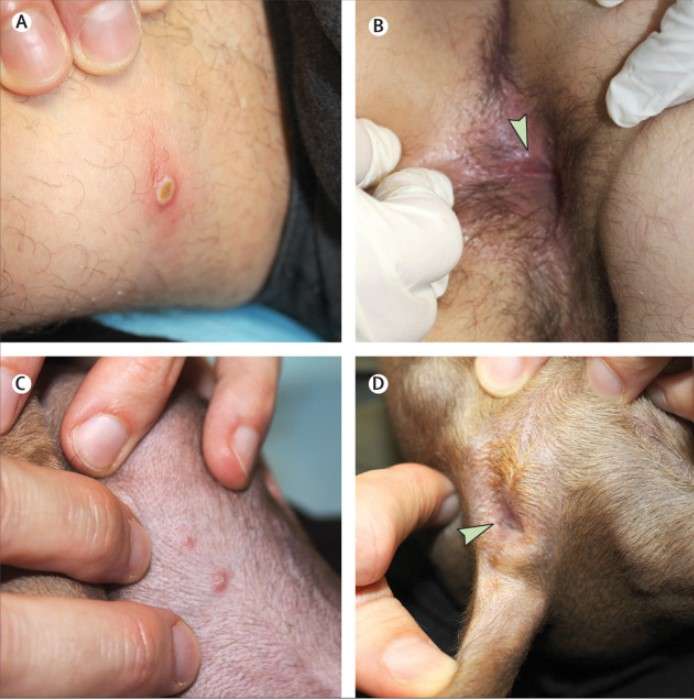 Lésion pustulaire de la cuisse, avec ombilication centrale et début de nécrose, chez le patient 1 (photo A). Lésions anales érosives et pustuleuses chez le patient 2 (photo B). Deux papules érythémateuses légèrement croûteuses chez le chien (C). Lésion anale érosive millimétrique chez le chien (D). © Seang, Burrel, Todesco et al.