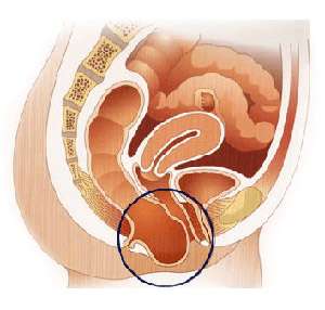 Les causes de l'incontinence urinaire sont nombreuses. Il peut s'agir par exemple d'un prolapsus, ou descente d’organe (dont on voit le schéma ci-dessus). © Groupe Urologie- Saint-Augustin DR