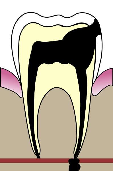 Quand la carie se complique, elle peut engendrer une nécrose de la dent, appelée cellulite faciale. © Wikipédia, Licence Art libre