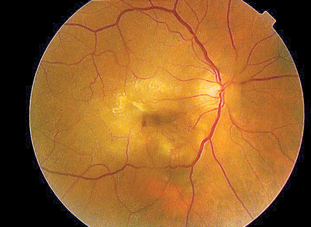 La DMLA humide est liée à la prolifération de vaisseaux sanguins qui fuient et créent un œdème dans la rétine. © Community Eye Health, Flickr