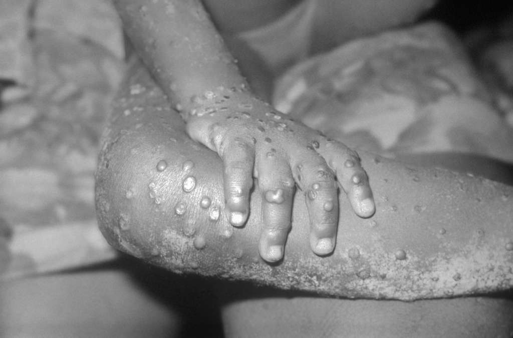 Lésions de variole du singe sur le bras et la jambe d'une fillette de 4 ans, à Bondua, comté de Grand Gedeh, Libéria. © Centers for Disease Control and Prevention (CDC, États-Unis), Wikimedia Commons. Domaine public