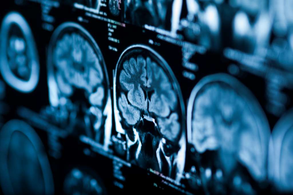 Exemple d'imagerie par résonance magnétique (IRM) du cerveau humain. © merydolla, Adobe Stock