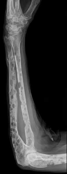 Le myélome multiple est un cancer au niveau de la moelle osseuse des os. Il peut s'observer sur une radiographie du squelette : des taches plus sombres indiquent la dégradation de l'os par les tumeurs. Ici, il s'agit de l'avant-bras d'un patient. © Hellerhoff, Wikimedia Commons, cc by sa 3.0