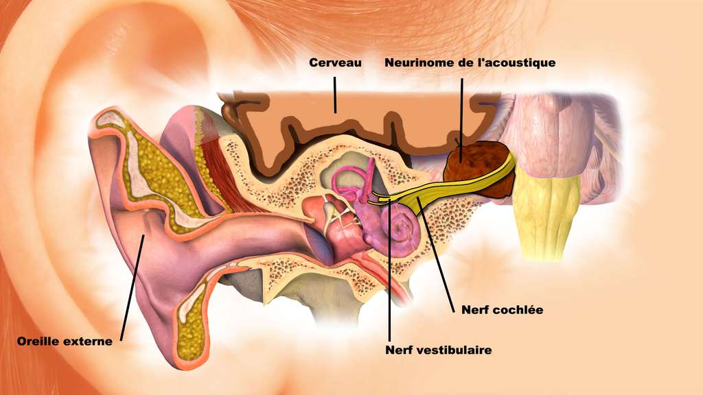 Le neurinome de l’acoustique Le neurinome de l’acoustique