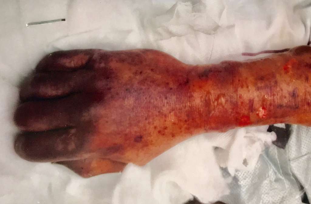 Les doigts nécrosés du patient atteint de purpura fulminans. © Naomi Mader, European Journal of Case Reports in Internal Medicine