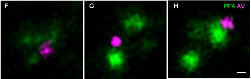 Les particules PF4 sécrétées par les thrombocytes (en vert) se lient avec l’adénovirus (rose) pour former des complexes qui peuvent déclencher une réaction auto-immune. © Andreas Greinacher et al., Research Square, 2021