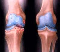 Osteoarthritis is a disease that affects the joints.