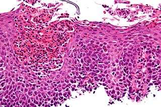 Eosinophilic esophagitis: numerous eosinophils are infiltrated in the mucous membrane.  © Nephron, Wikipedia Commons CC by-sa 3.0