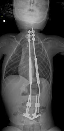 Radiographie du garçon après la pose des tiges. © Communiqué de presse du CHU d’Amiens-Picardie Radiographie du garçon après la pose des tiges. © Communiqué de presse du CHU d’Amiens-Picardie
