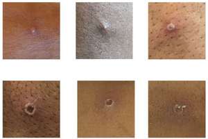 Différentes lésions cutanées causées par la variole du singe. © UKHSA