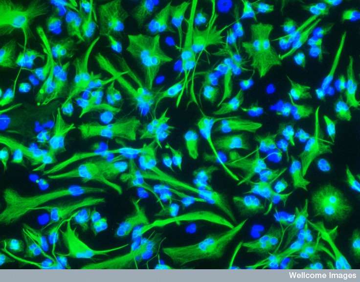 Cellules cancéreuses du cerveau en culture. Cette étude pourrait ouvrir la voie vers un traitement de ce type de cancer chez l’Homme. © Steven Pollard, Wellcome images, cc by nc nd 2.0