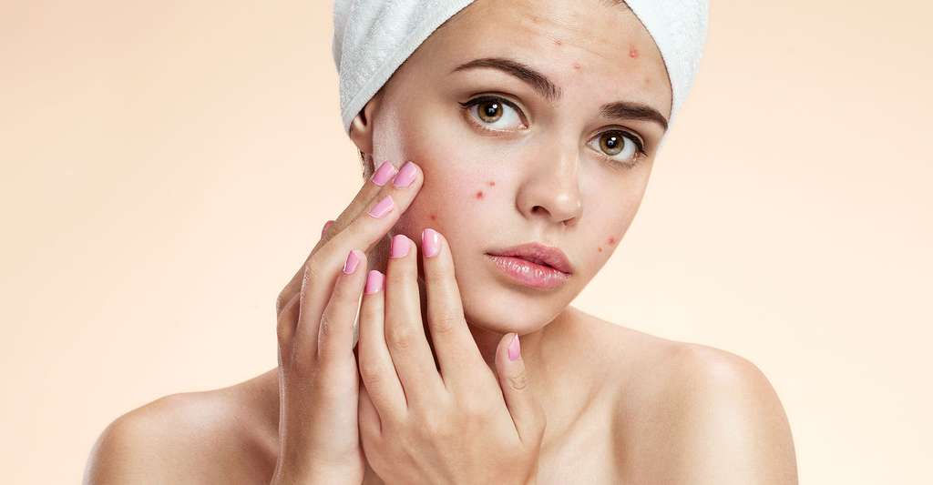 Acne: all you need to know about acne |  Folder