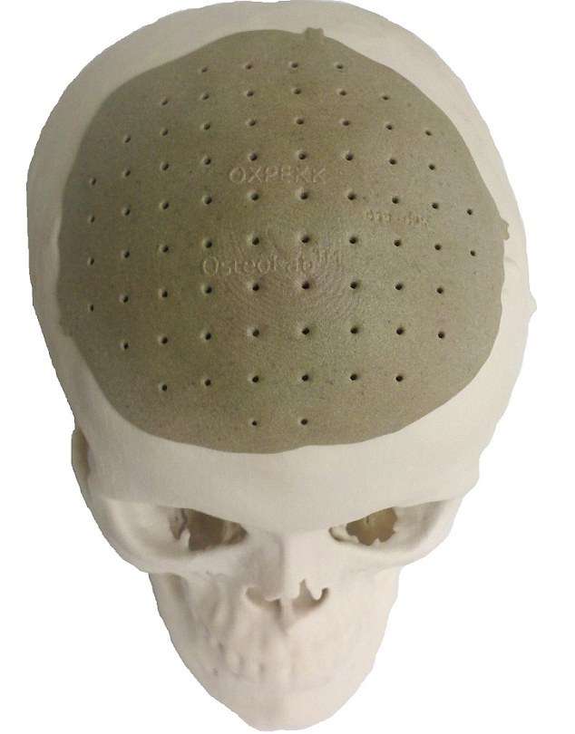 L'implant crânien est façonné à partir des besoins du patient. Il est prêt à remplacer les parties du crâne détruites en deux semaines. © Oxford Performance Materials