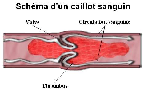 Le caillot sanguin, ou thrombus, apparaît lorsque le sang coagule. Tant qu'il est de petite taille, il ne présente pas encore un grand danger. Mais s'il grossit jusqu'à obstruer le vaisseau, il crée une thrombose potentiellement mortelle. Les techniques actuelles de pontage peuvent causer une telle pathologie. Mais les artères d'autruche possèdent naturellement des anticoagulants. © Matth97, Wikipédia, cc by 3.0