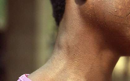 Photo : 12 - Inflammation d'un nœud lymphatique au niveau du cou, décelable à la palpation chez un malade. © Gérard Duvallet.
