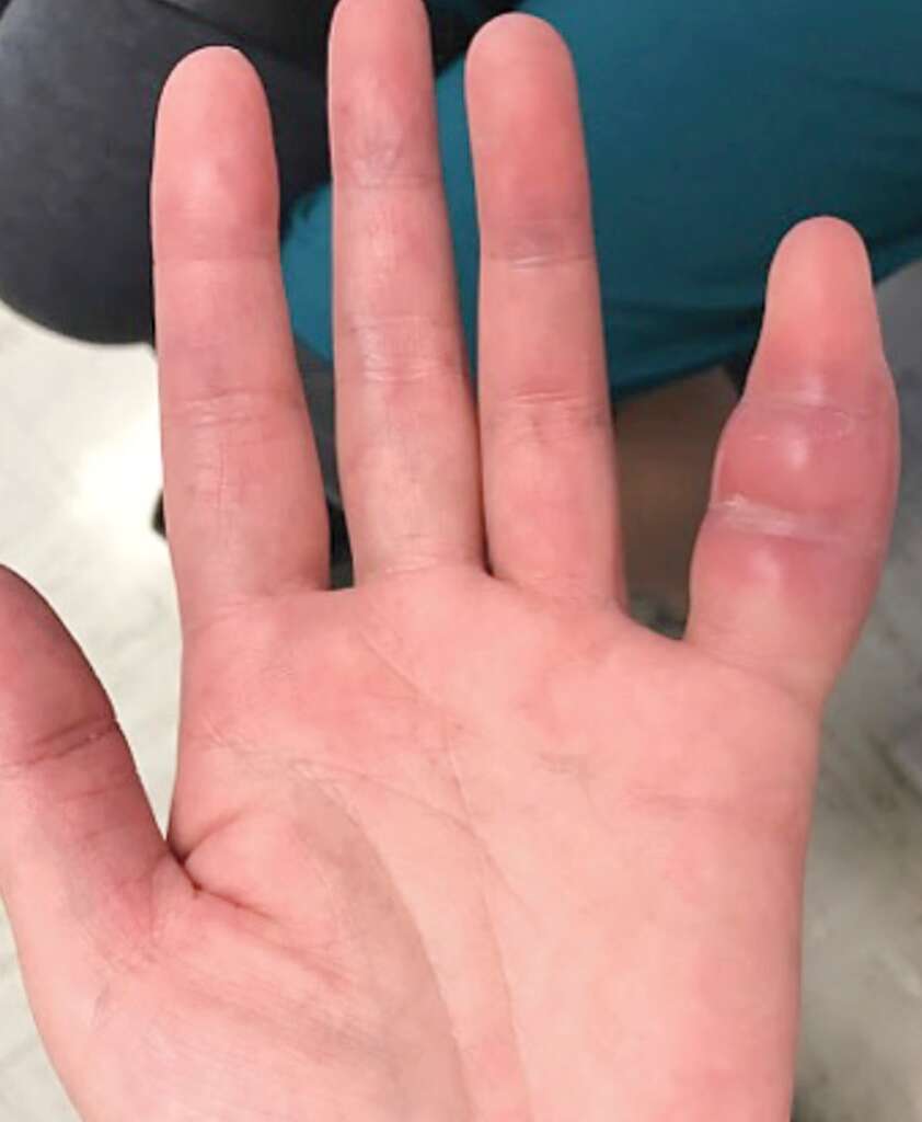 Photographie du doigt de la patiente. © Mandal et Margaretten 2018, New England Journal of Medicine