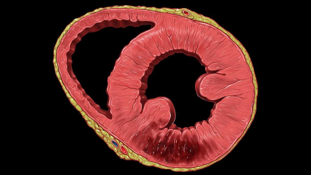 Infarctus dans le ventricule gauche Infarctus dans le ventricule gauche