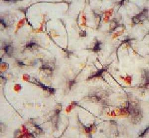 Dans le cadre d'une recherche sur le développement des greffes neuronales pour soigner les maladies de Parkinson et de Hutington, deux équipes suédoise et espagnole ont réalisé des cultures de cellules souches exprimant un gène capable de coder une protéine nécessaire à la production de dopamine (cellules orange). © RDT Info