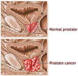 Cancer de la prostate : efficacité d'un changement de style de vie