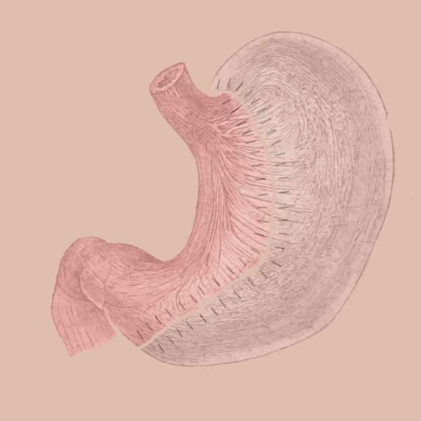 Schéma d'une gastrectomie longitudinale (sleeve). © Kwipedl Cyop, Wikimedia commons, CC 4.0