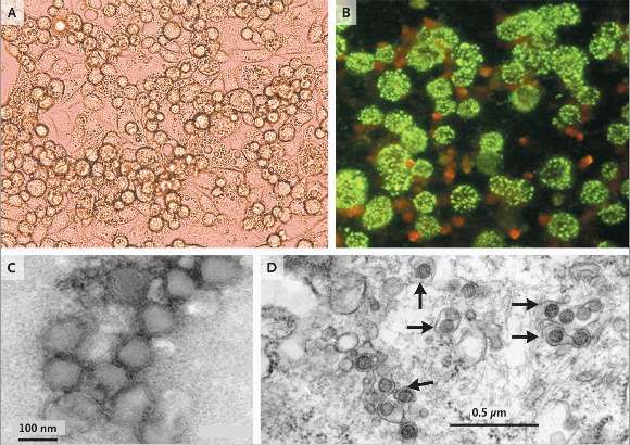 Le nouveau Phlebovirus, SFTSV, provoque une accumulation de granules dans le cytoplasme des cellules infectées (A et B). Les particules virales sont plus denses aux électrons (plus foncées au microscope électronique) et s'accumulent dans l'appareil de Golgi (C et D). © NEJM