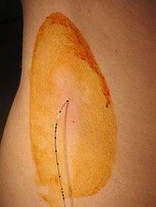 Péridurale. L’injection de l’anesthésique passe par un fin cathéter. © DR Péridurale. L’injection de l’anesthésique passe par un fin cathéter. © DR