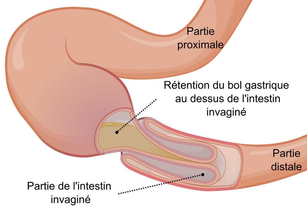 Invagination Intestinale Quels Sont Les Symptomes Et Les Traitements