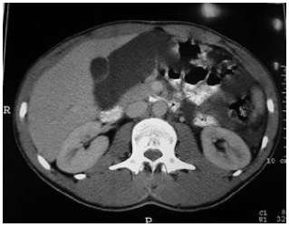 Scanner de l’abdomen : 5 ans d’irradiation naturelle © SFRP