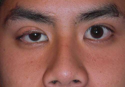 Ptosis congénital. © Andrewya, Wikimedia commons, DP
